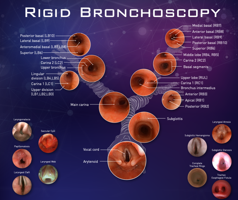 Rigid Bronchoscopy - Airway Anatomy
