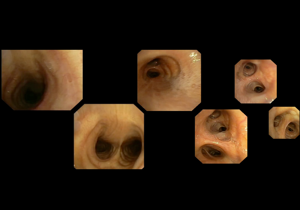 Right Bronchial Tree - Real Bronchoscopy Views
