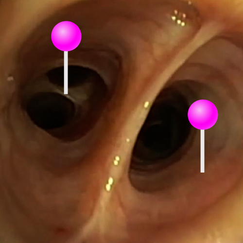 Trachea and Carina - Real Bronchoscopy View