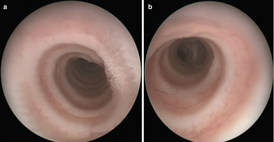 Complete Tracheal Rings - Real Bronchoscopy View