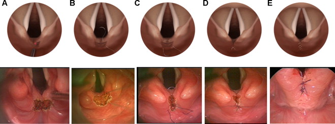 Laryngeal Cleft - Real Endoscopic View