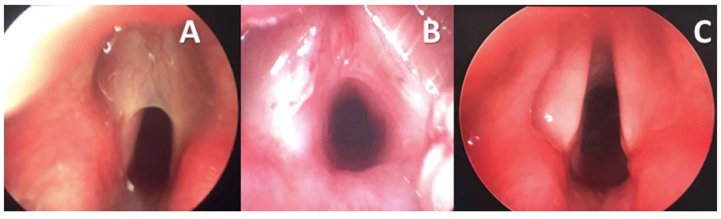 Laryngeal Web - Real Endoscopic View