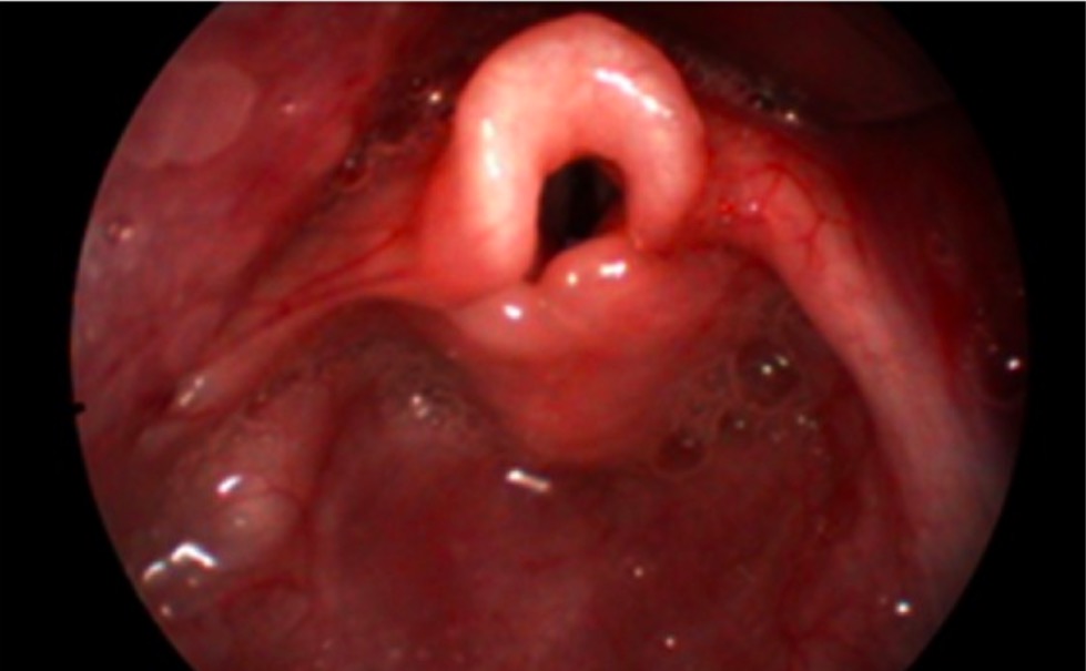 Laryngomalacia - Real Endoscopic View