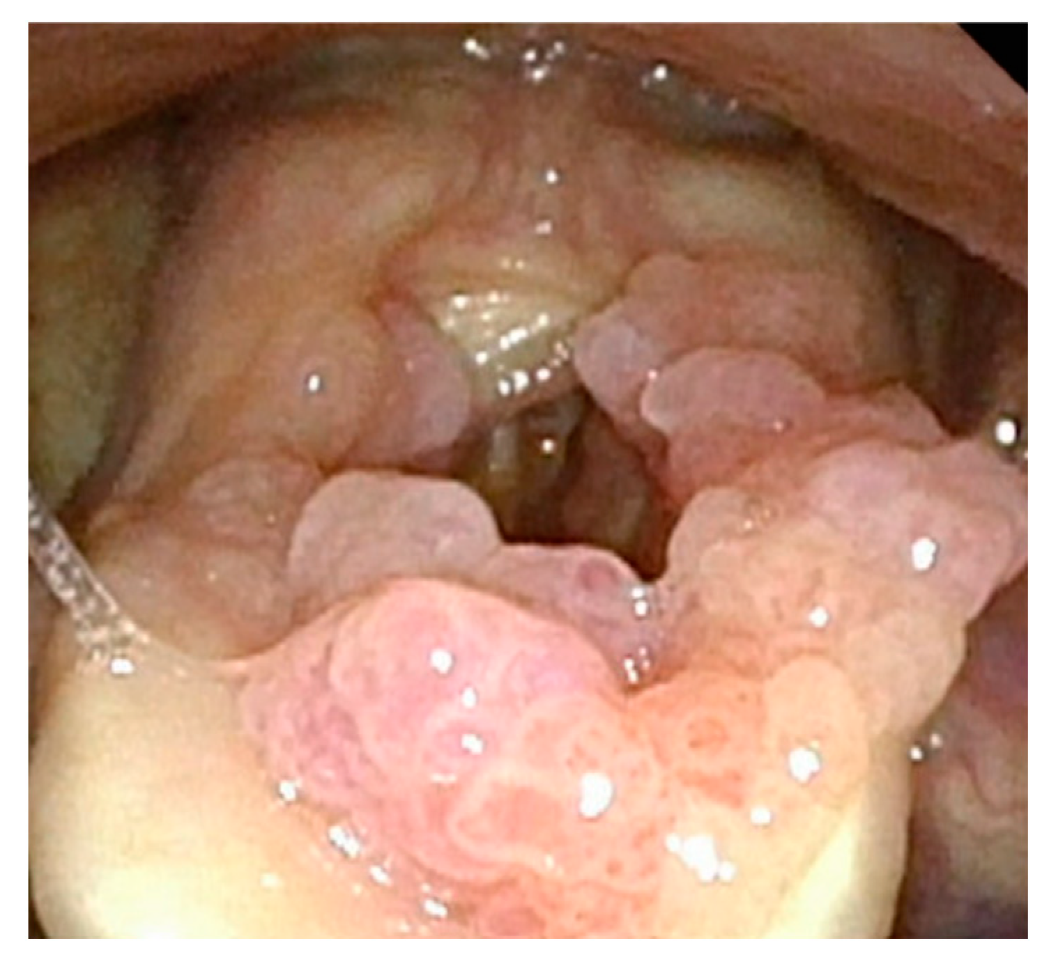 Recurrent Respiratory Papillomatosis - Real Endoscopic View