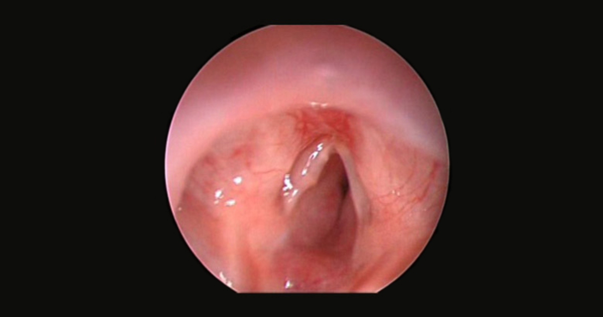Subglottic Hemangioma - Real Endoscopic View