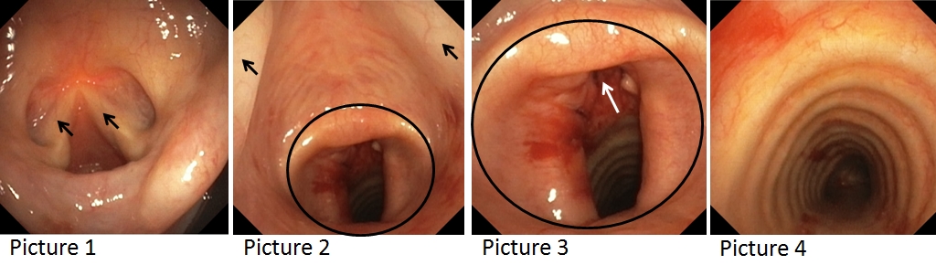 Subglottic Stenosis - Real Bronchoscopy Views