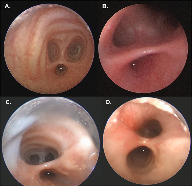 TEF - Real Bronchoscopy View