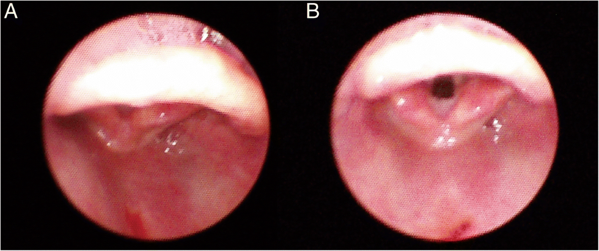 Vocal Cords Anatomy - Real Laryngoscopy View